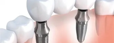 Business 3 image TOOTH IMPLANTS Dentists in Delmar NY
