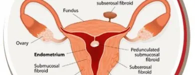 Business 1 image USA FIBROID CENTERS Uterine Fibroid Removal in Arlington TX