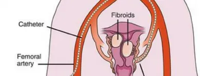 Business 3 image USA FIBROID CENTERS Uterine Fibroid Removal in Arlington TX