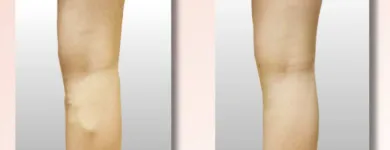 Business 4 image USA VEIN CLINICS Vein Doctor in Brooklyn NY